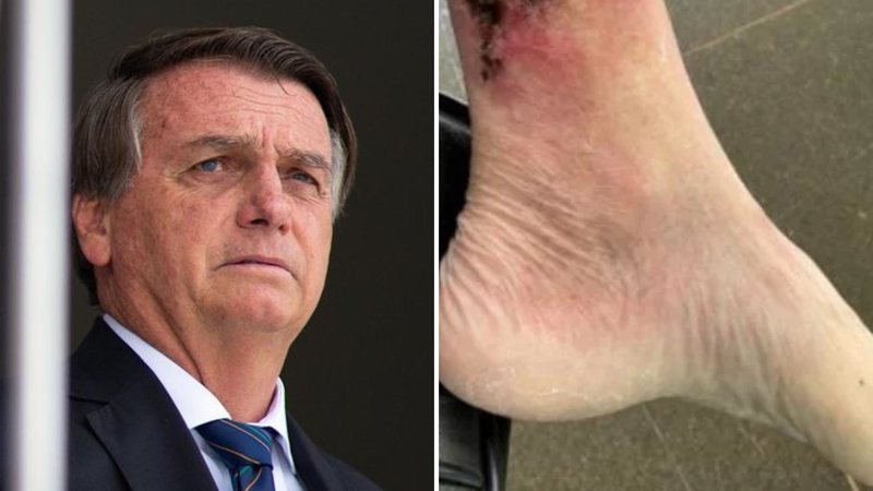 Carlos Bolsonaro publica imagem forte da perna do pai com doença grave: "Recuperação" - Reprodução/Instagram