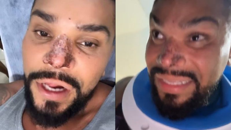 Naldo Benny contou como está se sentindo após sofrer um princípio de necrose no nariz - Reprodução/Instagram