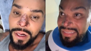 Naldo Benny contou como está se sentindo após sofrer um princípio de necrose no nariz - Reprodução/Instagram