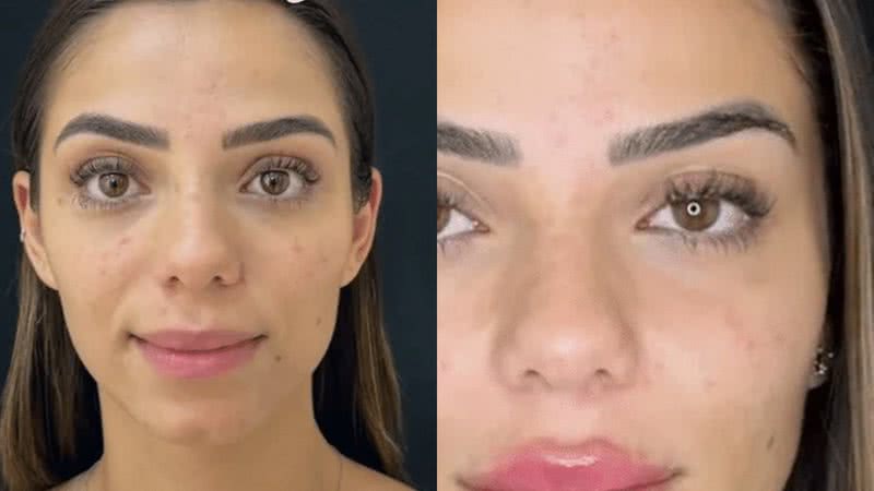 Keyt Alves exibiu o antes e depois de sua harmonização facial - Reprodução/Divulgação