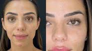 Keyt Alves exibiu o antes e depois de sua harmonização facial - Reprodução/Divulgação