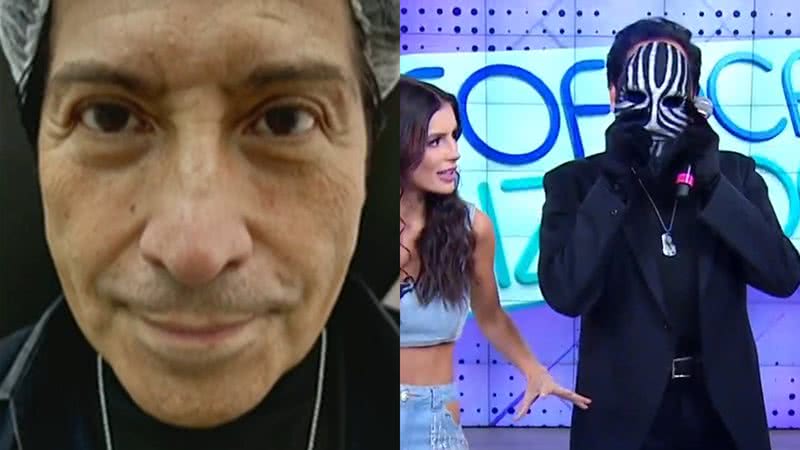 Mister M faz uma harmonização facial no Brasil - Reprodução/SBT