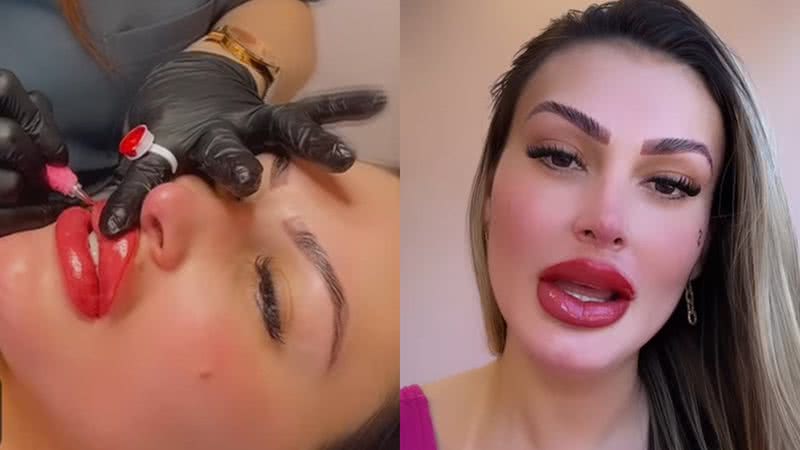 Andressa Urach exibiu o resultado de um novo procedimento estético - Reprodução/Instagram