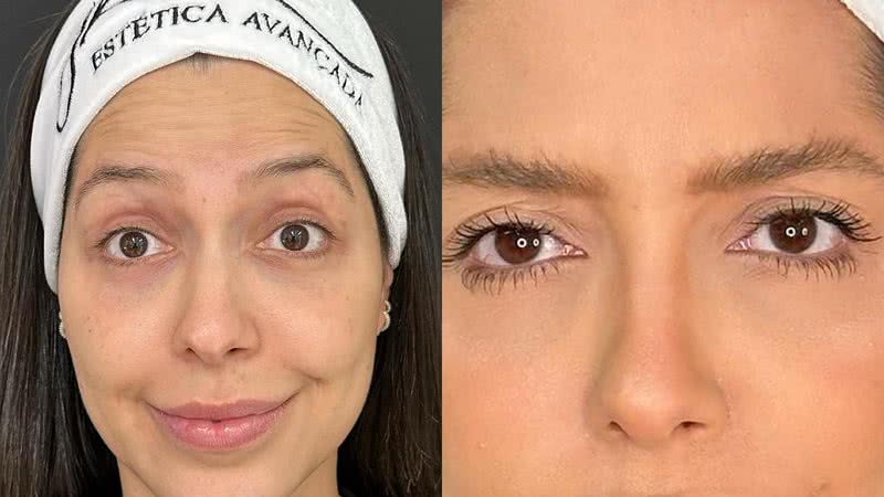 Laís Caldas dividiu opiniões ao exibir o resultado de sua harmonização facial - Reprodução/Instagram