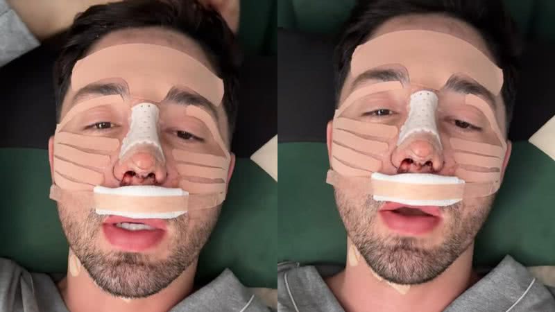 Rico Melquiades revelou como ficou seu nariz após passar por uma rinoplastia - Reprodução/Instagram