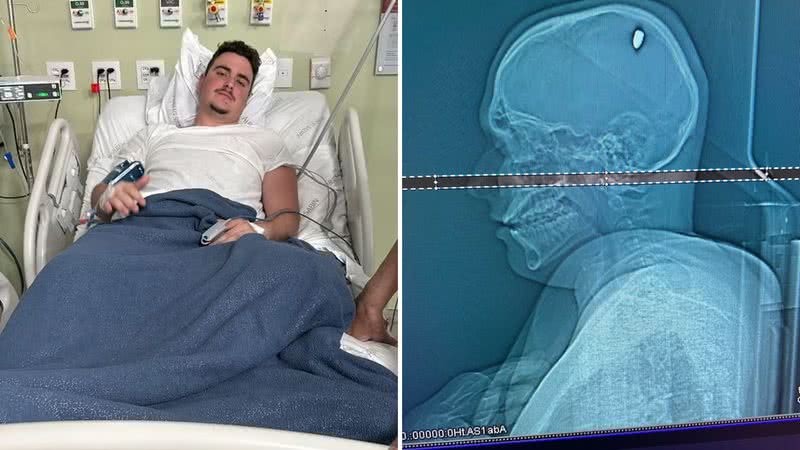 Estudante é baleado na cabeça, não percebe e passa 4 dias com projétil alojado - Reprodução/G1