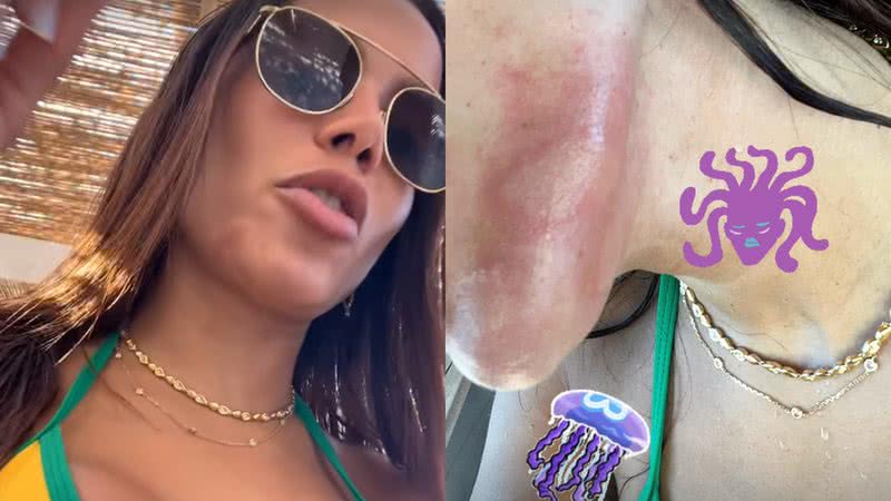 Anitta desabafou ao ser atacada por uma água-viva - Reprodução/Instagram