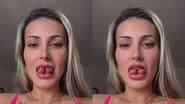 Andressa Urach mostra resultado de cirurgia de bifurcação da língua - Reprodução/Instagram