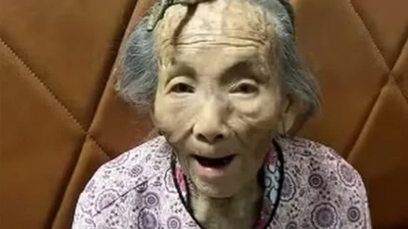 Idosa de 107 anos viraliza com ‘chifre’ de 10cm na testa - Reprodução