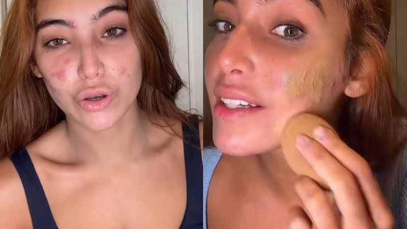 Vanessa Lopes entra em crise ao mostrar situação do rosto em tratamento para acne - Reprodução Instagram