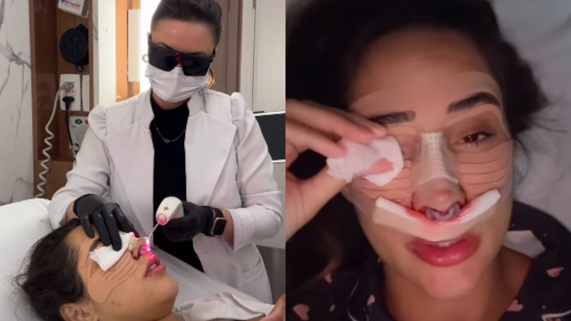 Deniziane exibe curativo após rinoplastia e desabafa: ‘Arde demais!’ - Reprodução/Instagram