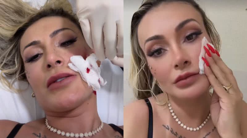 Andressa Urach apanha de Juju Ferrari e é hospitalizada ensanguentada: ‘Vai ter volta’ - Reprodução/Instagram