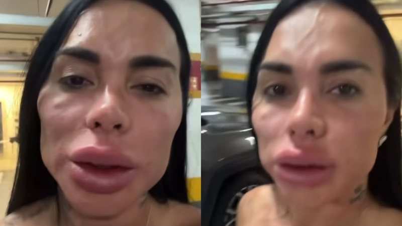 Kamila Simioni exibe resultado de procedimento estético no rosto; veja o antes de depois - Reprodução/ Instagram