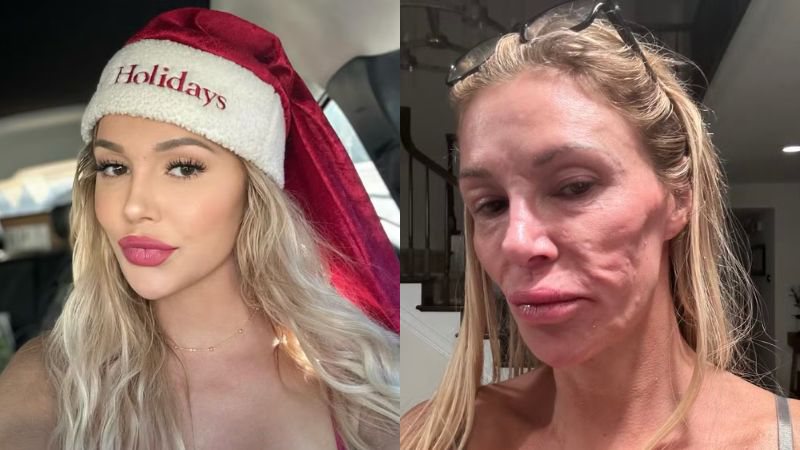 Brandi Glanville antes e depois de ter o rosto desfigurado - Reprodução/Instagram