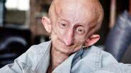 O que é progeria? Jovem de 19 anos morreu após doença do envelhecimento precoce - Reprodução/Instagram