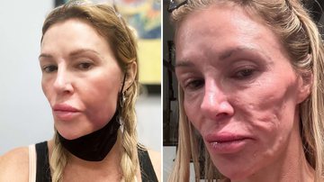 Quem é Brandi Glanville? Modelo ficou com o rosto 'derretido' após diagnóstico - Reprodução/Instagram