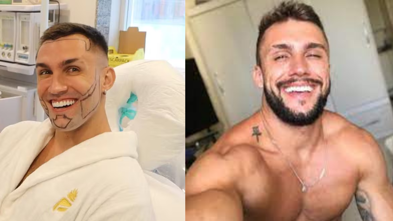 Ex-bbb Arthur Picoli surpreende ao aparecer após transplante capilar e de barba - Divulgação/ Instagram