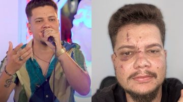 Sertanejo enfrenta 90 dias de recuperação após ter rosto desfigurado com garrafada - Reprodução/Instagram