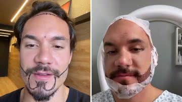 Transplante de barba feito por Eliezer custa caríssimo - Reprodução/Instagram