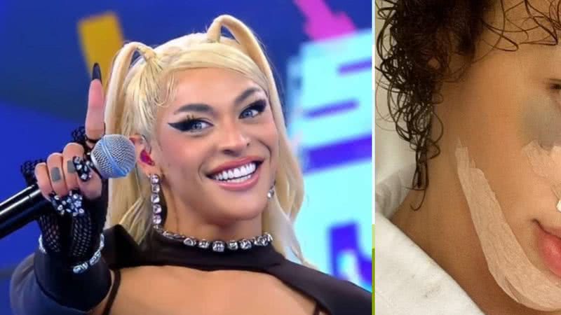 A cantora Pabllo Vittar ainda tranquilizou os fãs sobre seu estado de saúde; confira - Reprodução/TV Globo/ Instagram