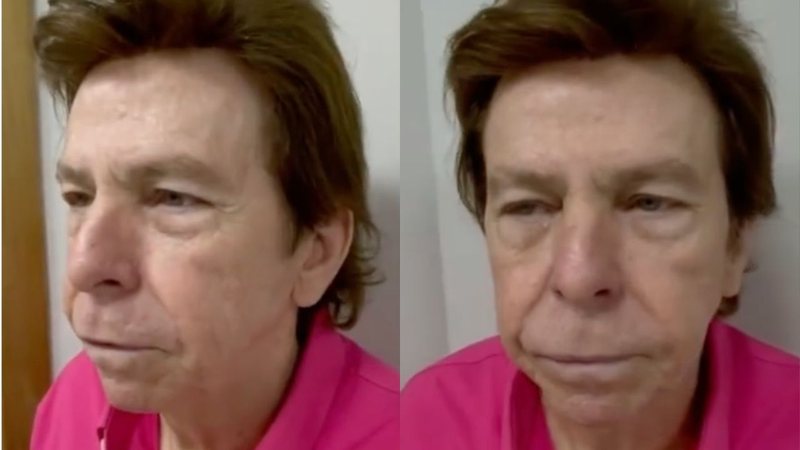 Nelson Rubens mostra antes e depois da harmonização facial e impressiona fãs: "Gostei mais" - Reprodução/TV Globo