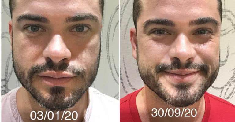 Sidney Sampaio mostra resultado do transplante capilar - Instagram