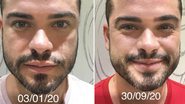 Sidney Sampaio mostra resultado do transplante capilar - Instagram