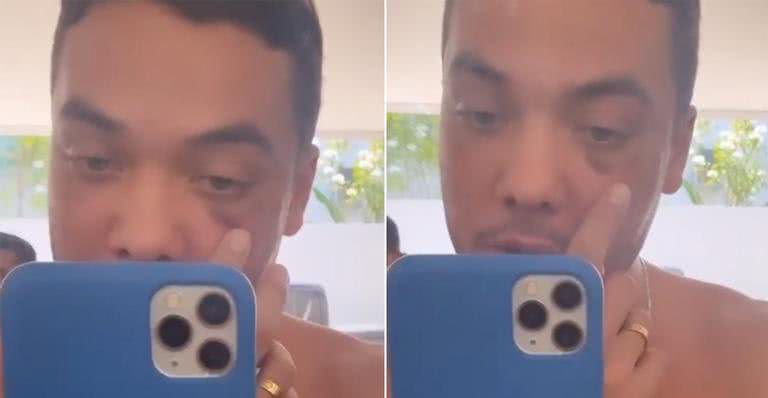 Wesley Safadão surge com o olho roxo e revela procedimento no rosto - Instagram