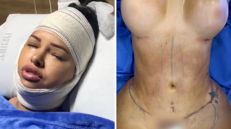 Imagens fortes: ex-BBB Ariadna Arantes compartilha fotos após cirurgias plásticas: "Na hora mudou" - Reprodução/Instagram