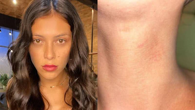 Atriz da TV Globo mostra hematomas no corpo após sofrer agressão por ataque transfóbico: "Sem chão" - Reprodução/Instagram