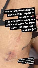 Liziane mostra clique dos hematomas na costela. é possível ver um inchaço grande na região, além de alguns arranhões e um machucado roxo