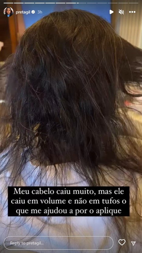 Preta Gil tira o aplique e mostra cabelo após a quimioterapia: "Caiu muito"