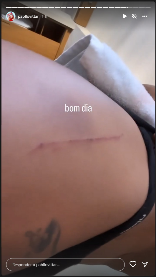 Foto de Pabllo Vittar mostrando corte na lateral do quadril com os escritos "Bom dia"