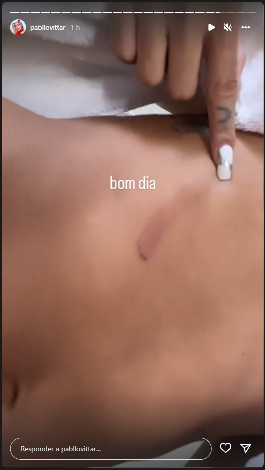 Foto de Pabllo Vittar mostrando machucado no abdômen com os escritos "Bom dia"