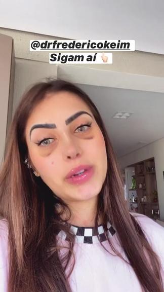 MC MIrella faz rinoplastia e mostra resultado nas redes