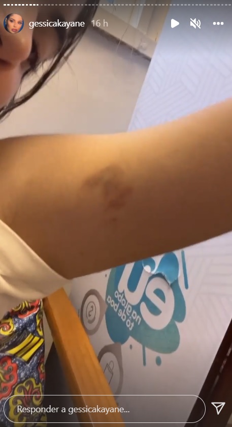 GKay surge cheia de hematomas no corpo e preocupa fãs: "Muito difícil"