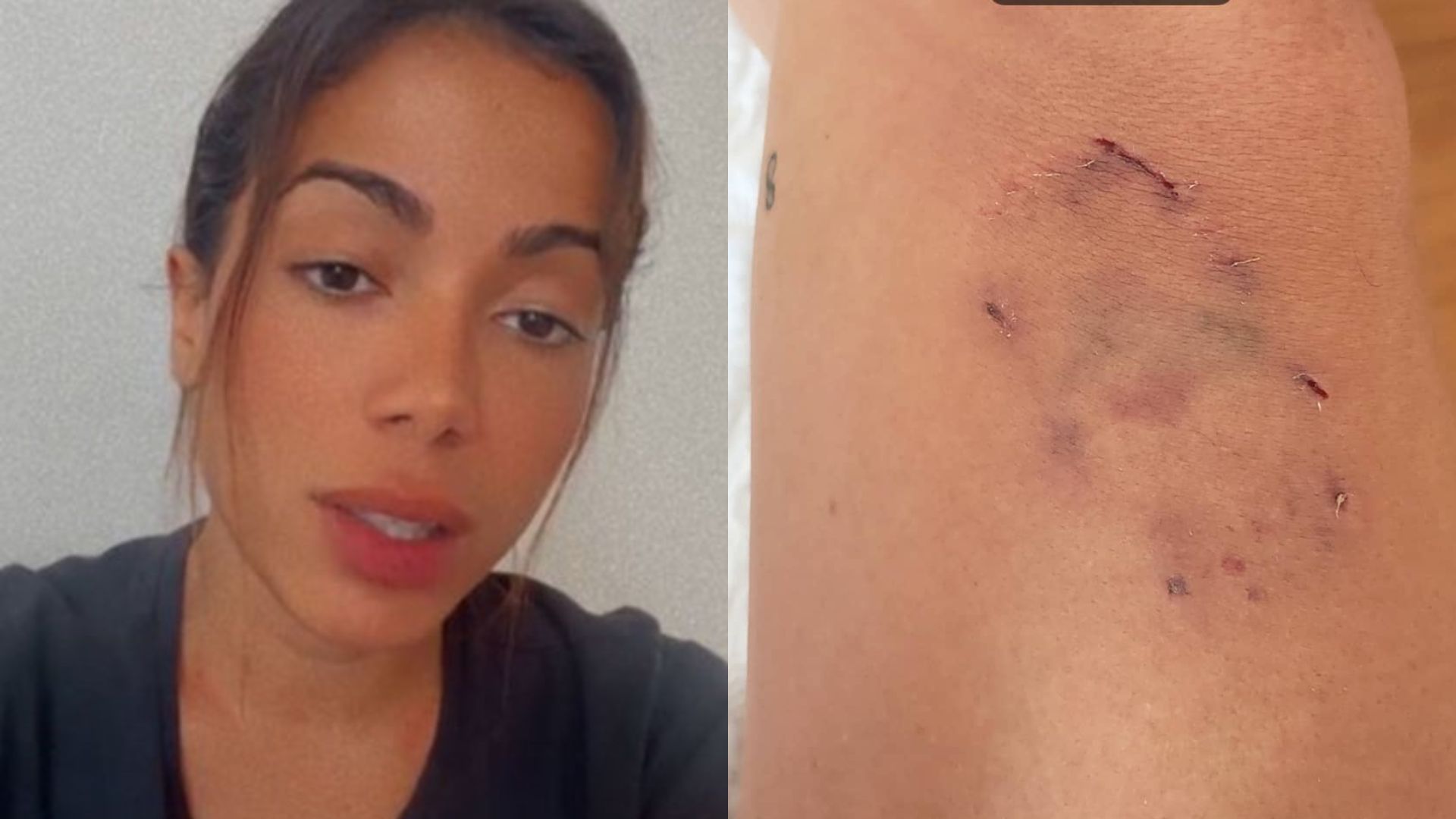 Anitta sofre acidente doméstico após briga entre seus cachorros: “Sobrou pra mim”