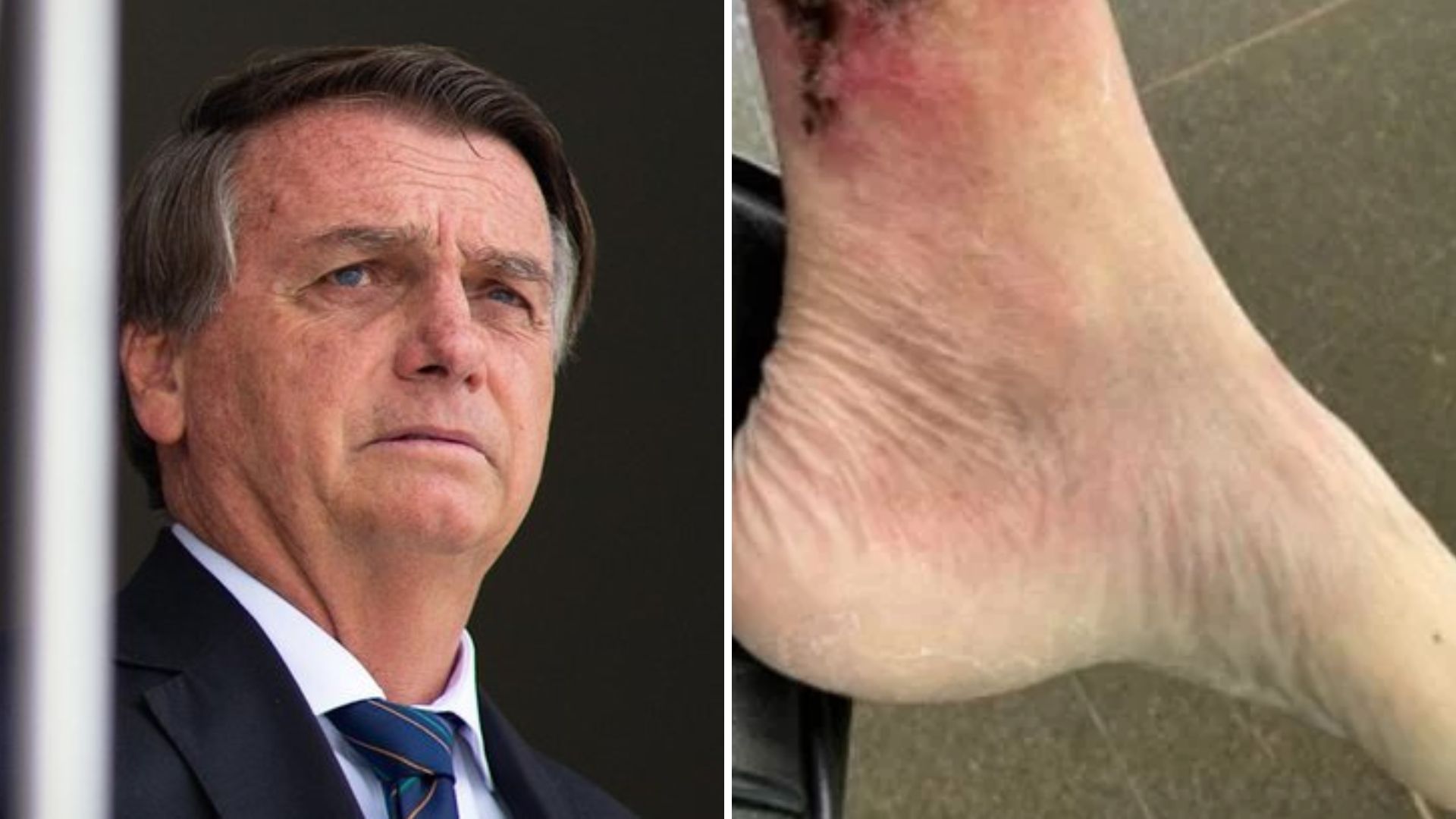 Carlos Bolsonaro publica imagem forte da perna do pai com doença grave: “Recuperação”