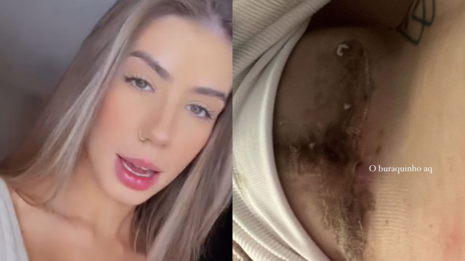 Ex de Whindersson Nunes estoura ponto de cirurgia e faz alerta: “Conscientizar”