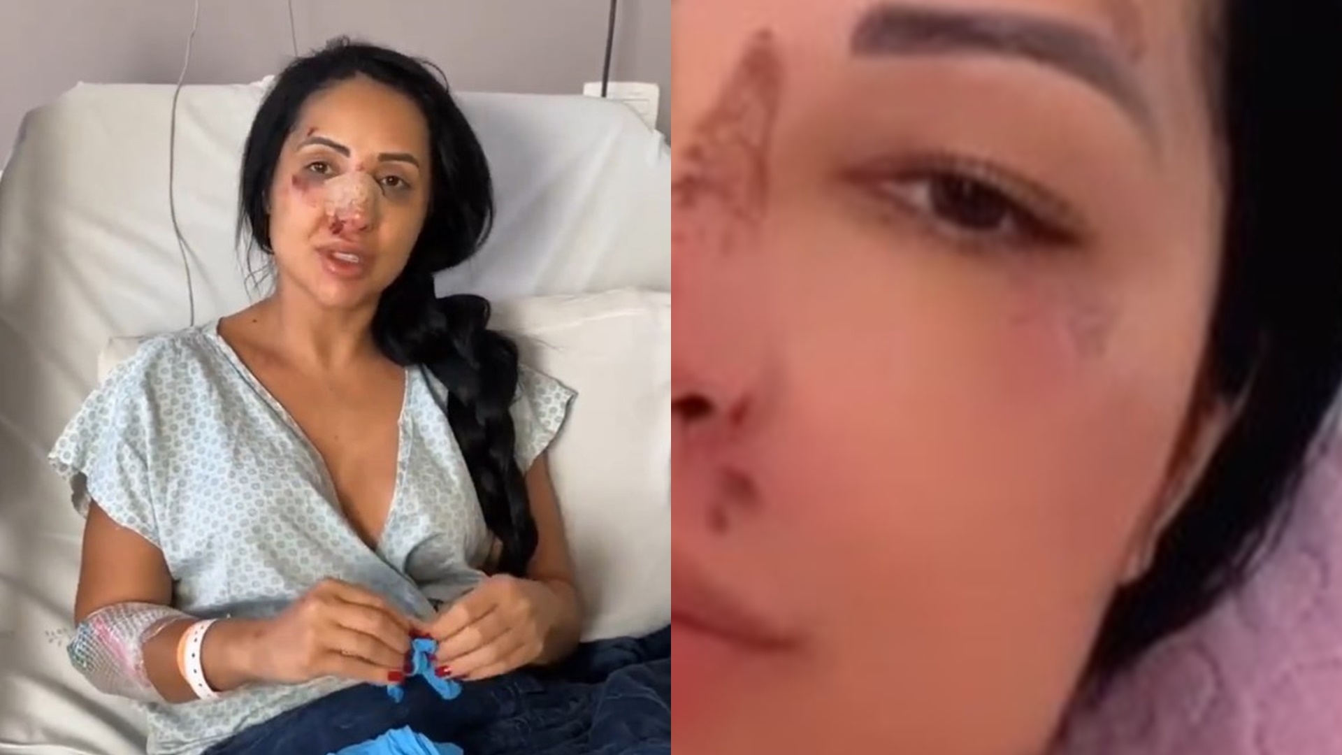 Irmã de Deolane retira curativo após estraçalhar nariz em briga e passar por cirurgia