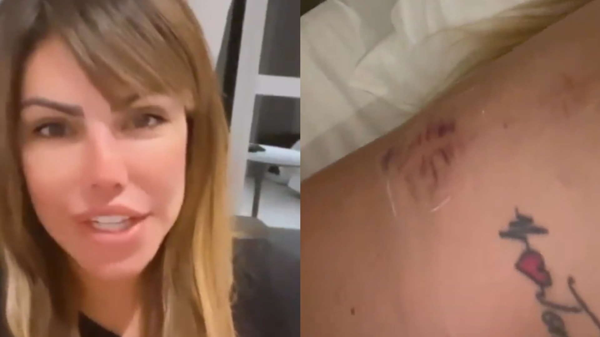 Liziane Gutierrez sai na porrada e termina com fratura na costela: “Muito inchado”