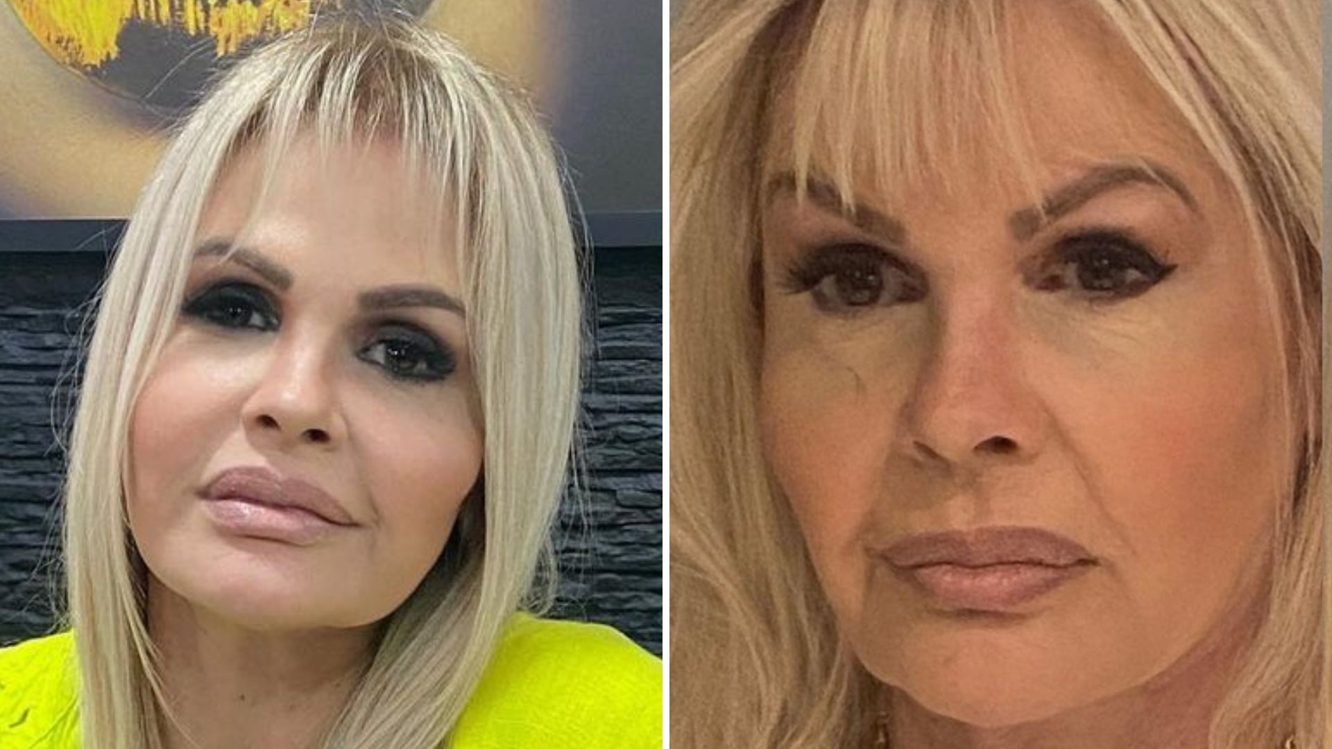 Monique Evans faz procedimento no rosto e mudança impressiona: “Resultado incrível”
