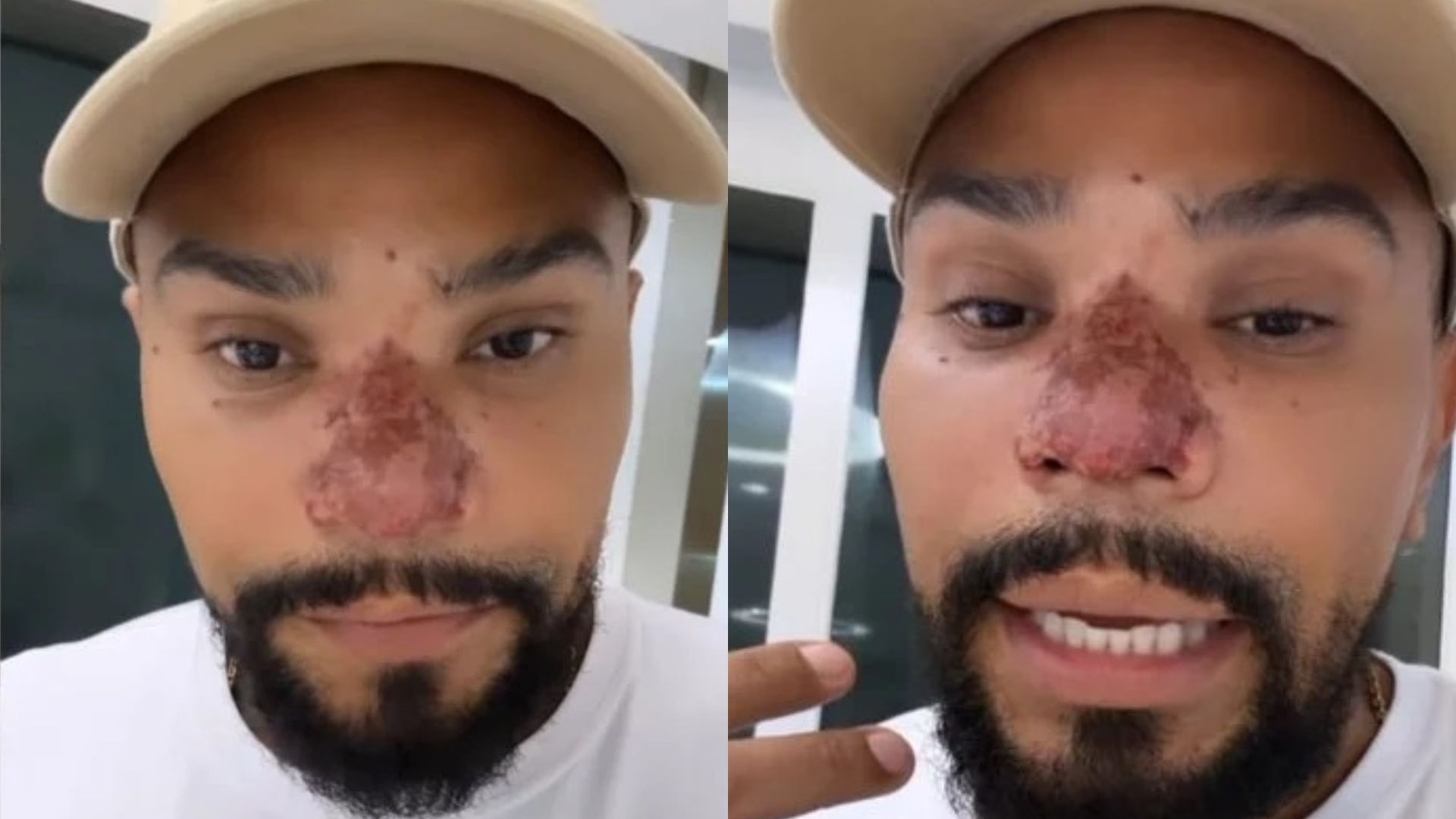 Naldo preocupa fãs ao surgir com mancha escura no nariz e desabafa: “Bem castigado”