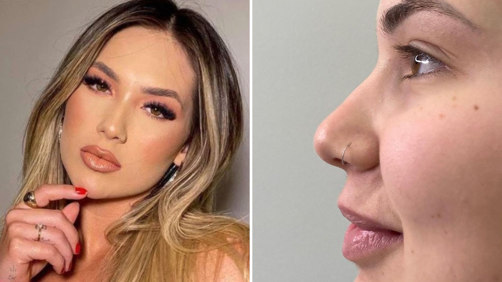 Virgínia Fonseca faz procedimento no nariz e mostra antes e depois: “Ficou perfeito”