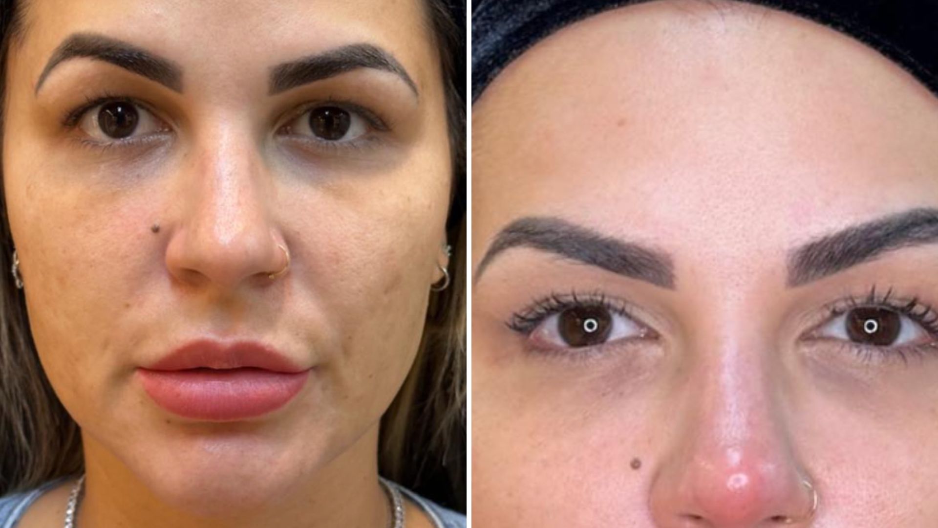 Deolane Bezerra refaz harmonização facial e retira preenchimento: “Natural”