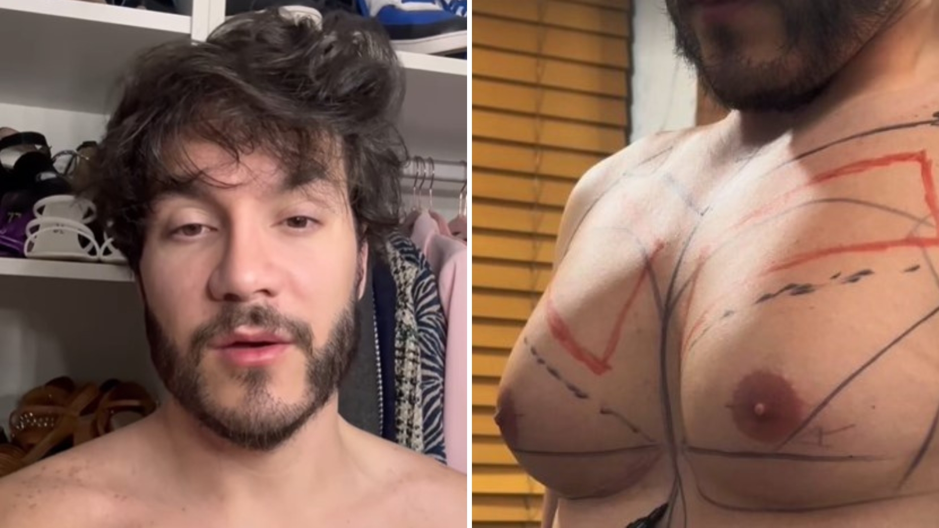 Saiu caro! Ex-BBB Eliezer revela o preço de cirurgia de ginecomastia: “Paguei”