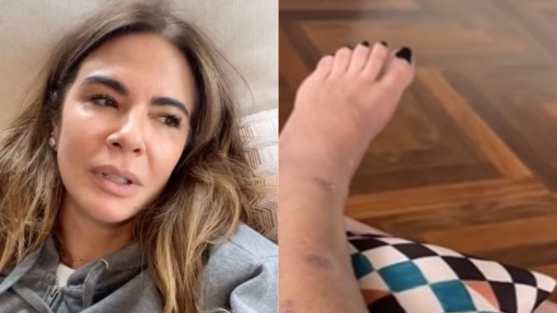 Imagens fortes! Luciana Gimenez surpreende ao mostrar cicatriz na perna desde o grave acidente: “Um mês”