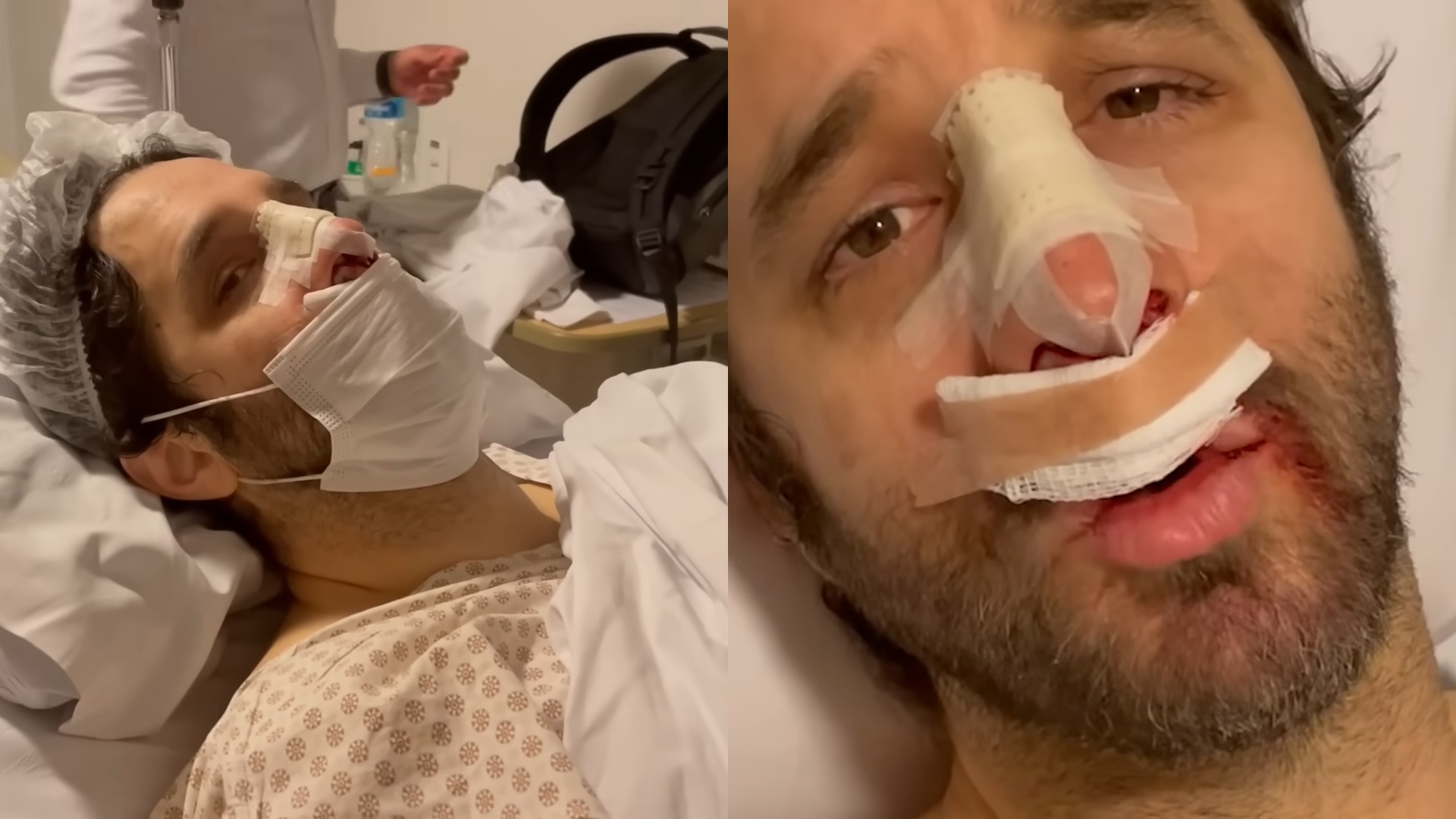 Aos 46 anos, Rafinha Bastos passa por cirurgia no nariz: “Perdi 12 quilos de nareba”