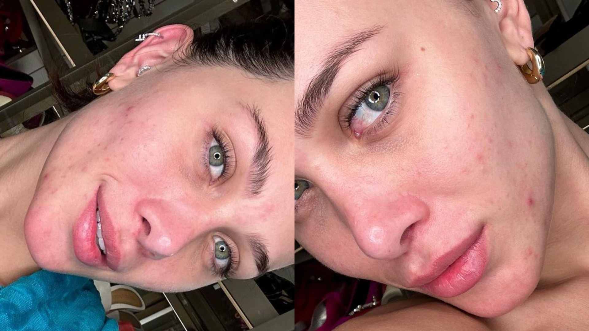 Flávia Pavanelli dispensa maquiagem e surge com rosto coberto de acne: “Pele real”
