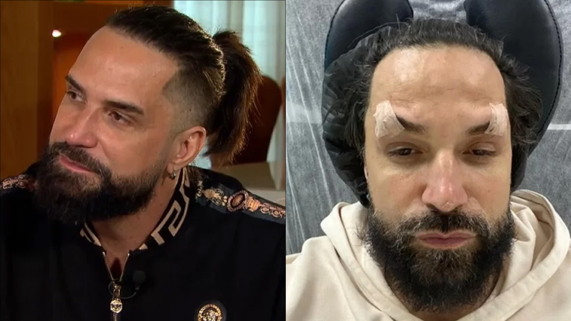 Não gostou? Latino admite susto com resultado de harmonização facial: “Feio”